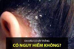 ảnh chụp màn hình da đầu bị bong tróc