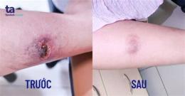 ảnh chụp màn hình da đau rát như bị bỏng