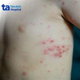 bỏng dạ và thủy đậu