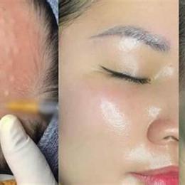 căng bóng da mặt