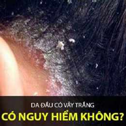 da đầu bị bong tróc