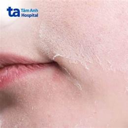 da mặt bị bong tróc