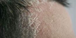 hướng dẫn sử dụng cách trị da đầu khô bong tróc tại nhà