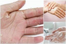 hướng dẫn sử dụng thuốc đặc trị bong tróc da tay