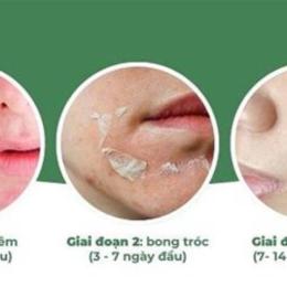 peel da bao lâu bong