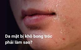 tính năng nổi bật da khô bong tróc bôi gì