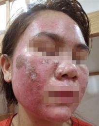 tính năng nổi bật da mặt bị bong tróc đỏ rát