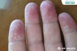 tính năng nổi bật đầu ngón tay bị bong tróc da là bệnh gì