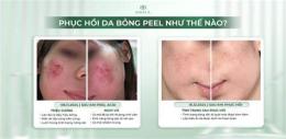 tính năng nổi bật hình ảnh peel da bị bỏng