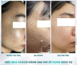 tính năng nổi bật peel da không bong tróc