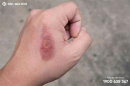 tính năng nổi bật vết bỏng bị tróc da nên bôi gì